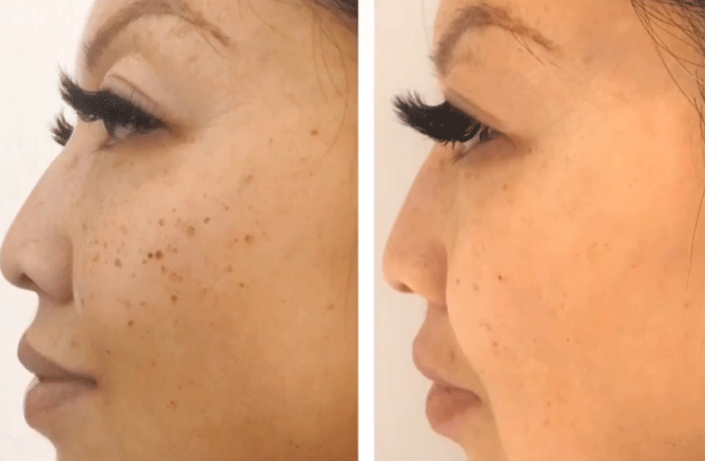 Case Study 001: Pigmentation & IPL